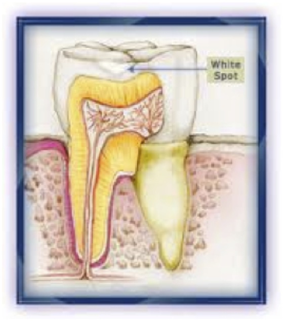 tooth repair2