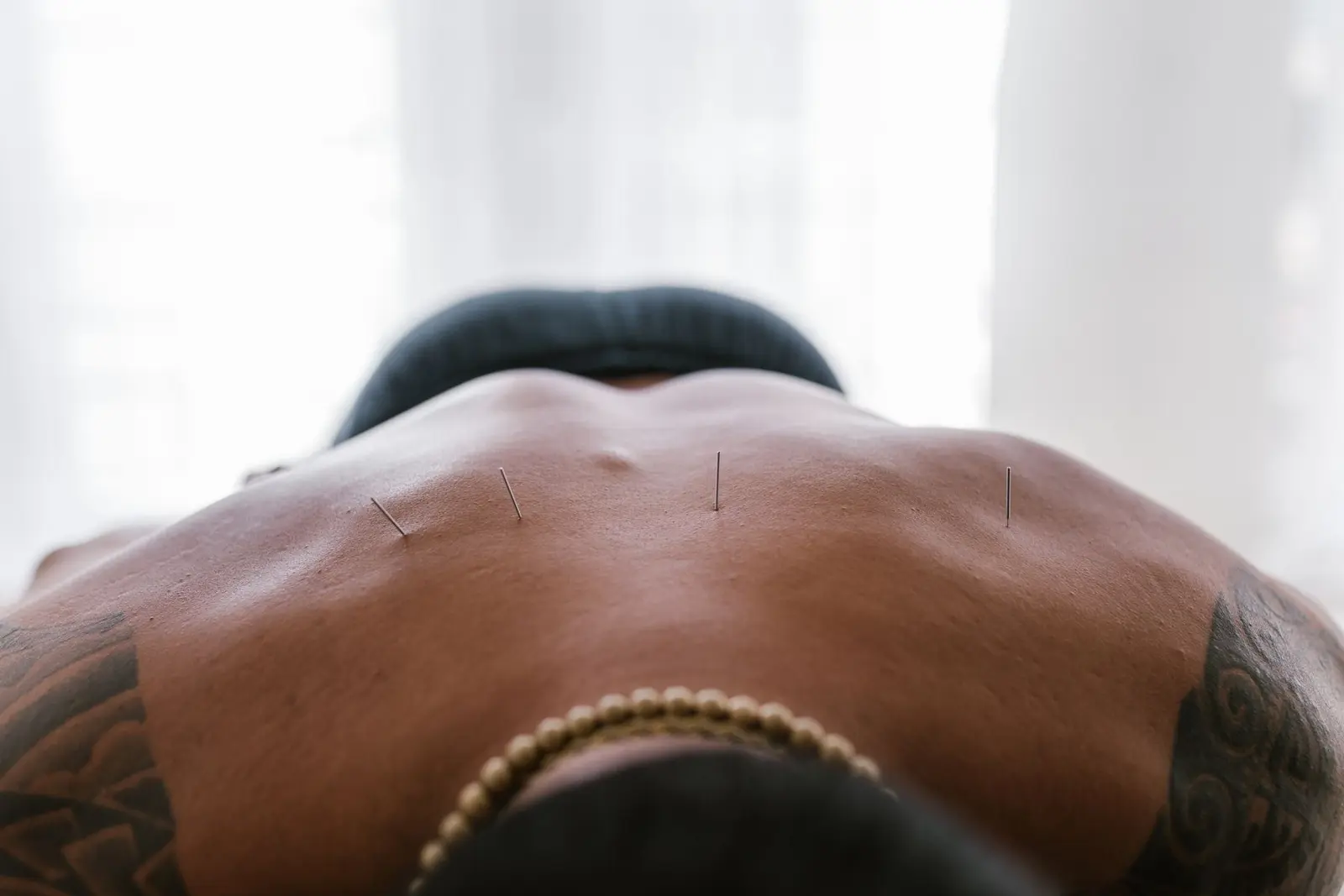 Man with tattoos lying face down with acupuncture needles along his back for back pain relief in Boca Raton