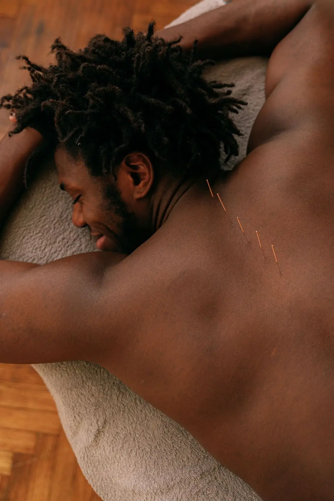 Man resting during acupuncture