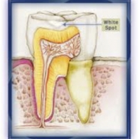 Dr. Love Minute for Health – Gum Abcess